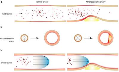 Biomechanical factors and atherosclerosis localization: insights and clinical applications